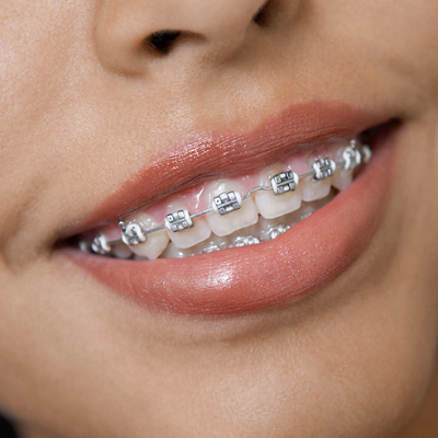 Dental Braces in Islamabad Pakistan - Teeth braces Cost